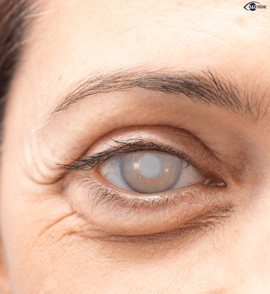 Cataract clouding illustration