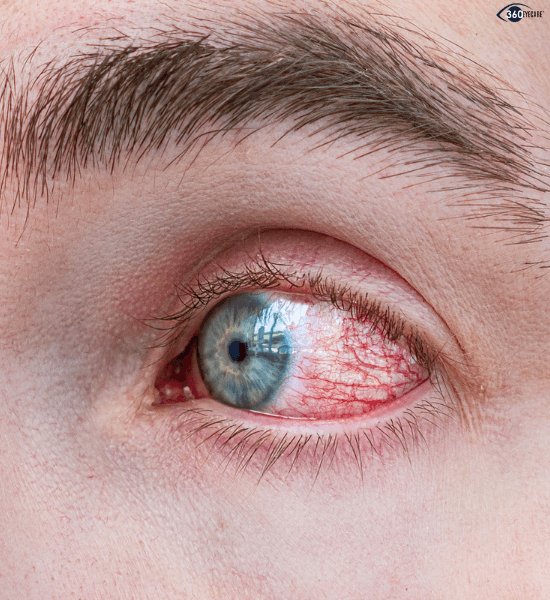Diabetic retinopathy blood vessel damage
