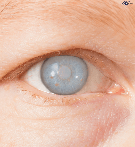 Glaucoma peripheral vision loss